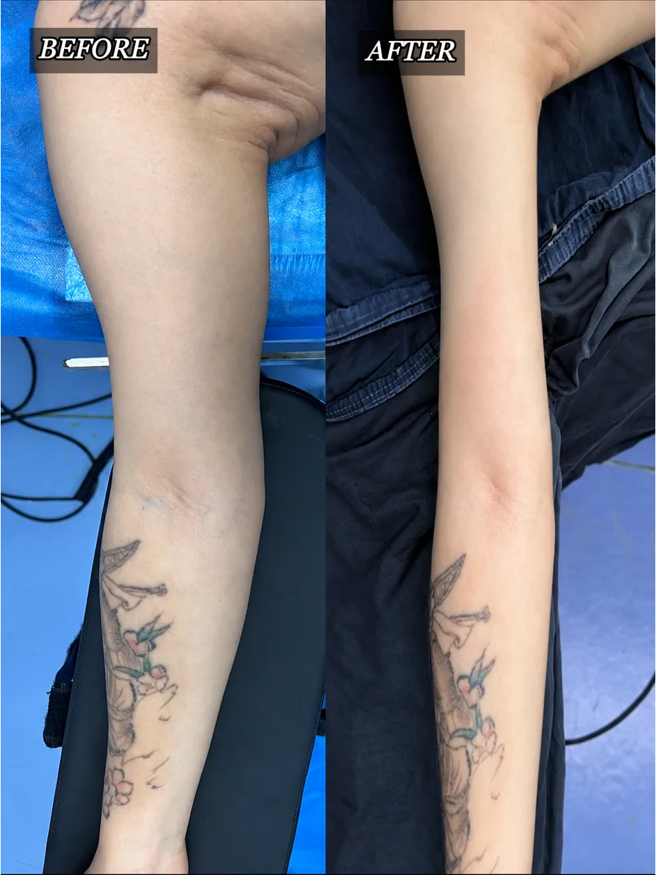 Authorized upper-arm liposuction case showing the patient's arm before treatment and at the supplied follow-up stage