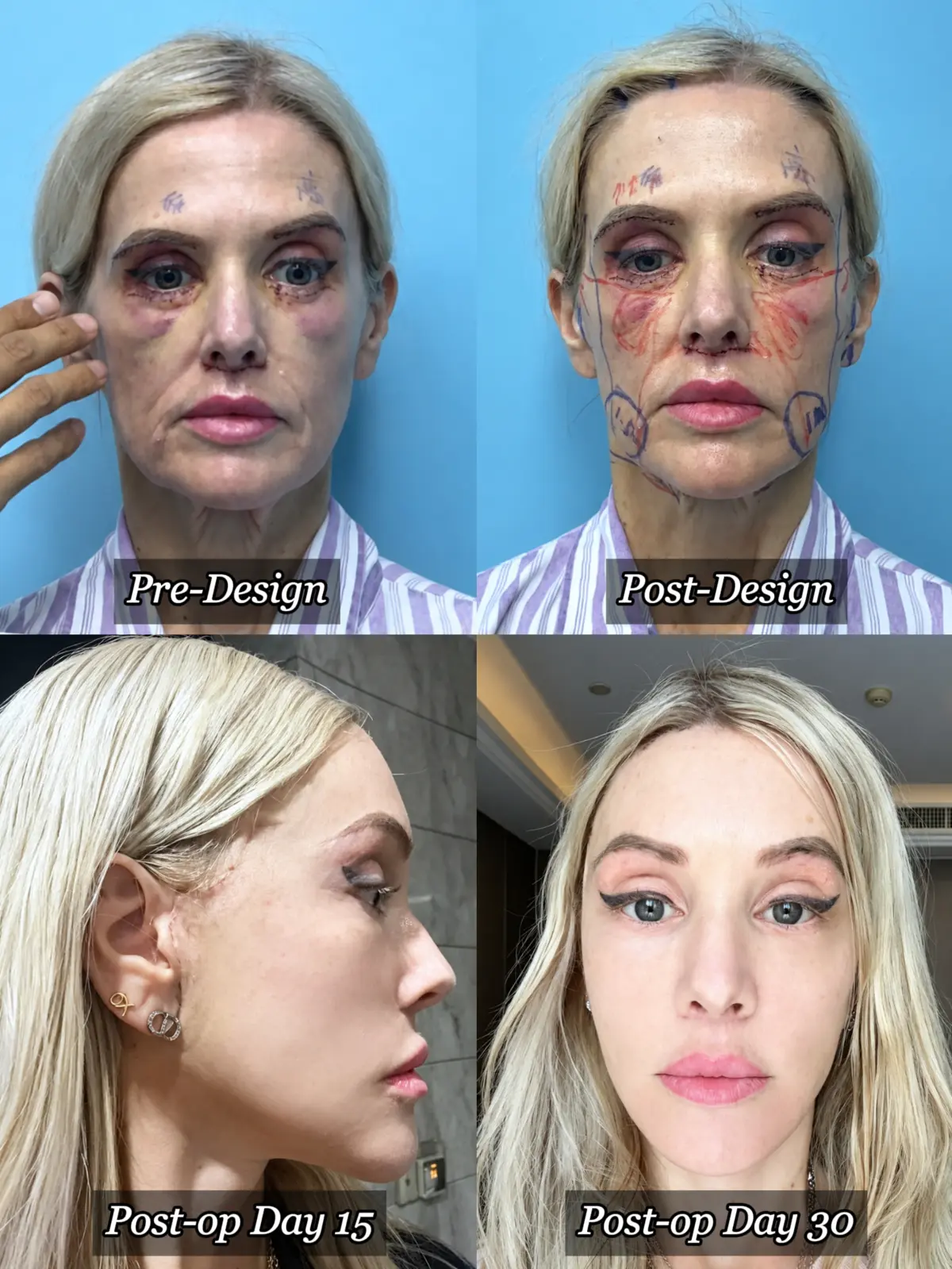 Authorized Australian patient recovery record with pre-operative design and postoperative day 15 and day 30 photographs