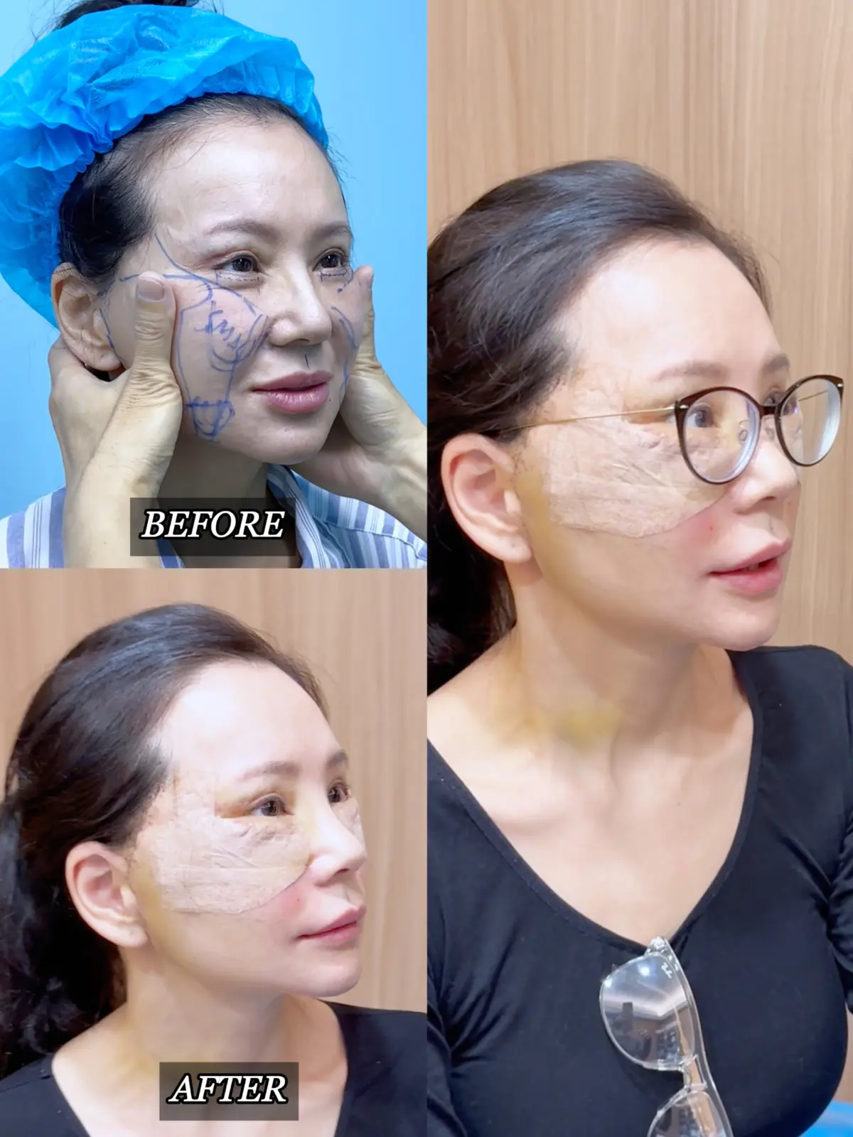 Authorized Singapore patient record showing pre-operative facial planning and early postoperative recovery