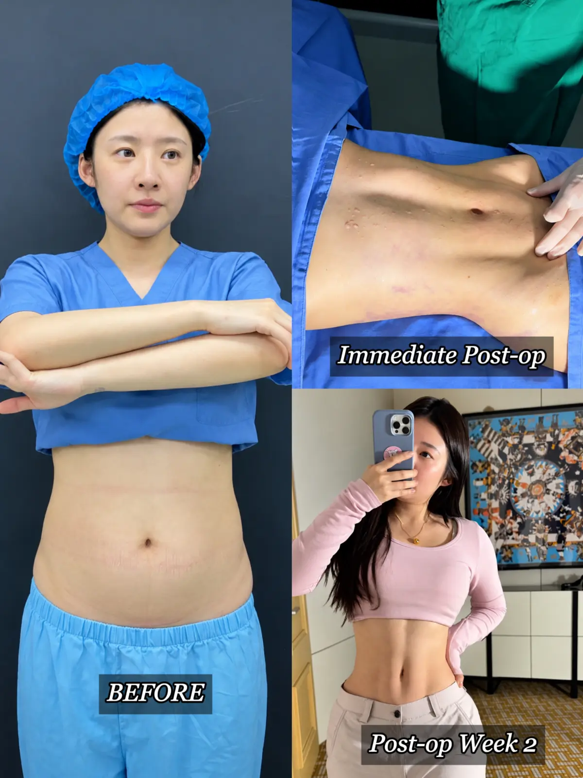 Authorized waist and abdomen recovery record showing before treatment, immediate postoperative stage and week two