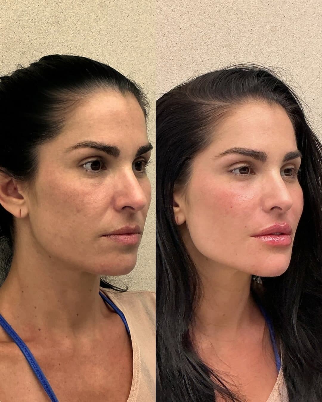 JadeLift patient image sequence